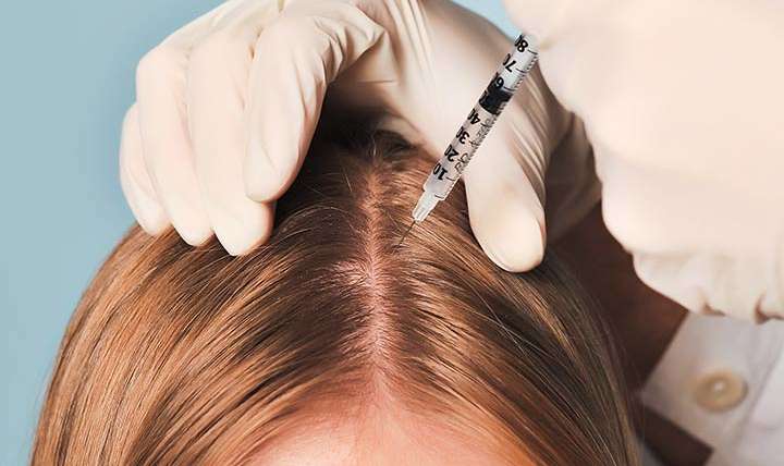 MESO THERAPY (HAIR LOSS SOLUTION)