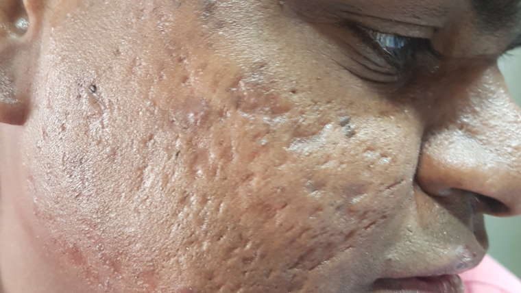 SCAR – POST ACNE, POST CHICKENPOX OR ANY CAUSE