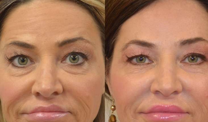 FACE LIFTING-NON SURGICAL WAYS